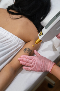 Person receiving laser tattoo removal on upper arm with cat tattoo and gloved hand nearby